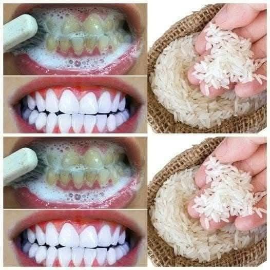 RAPID TEETH WHITENING in 1 Minute: Does It Work?