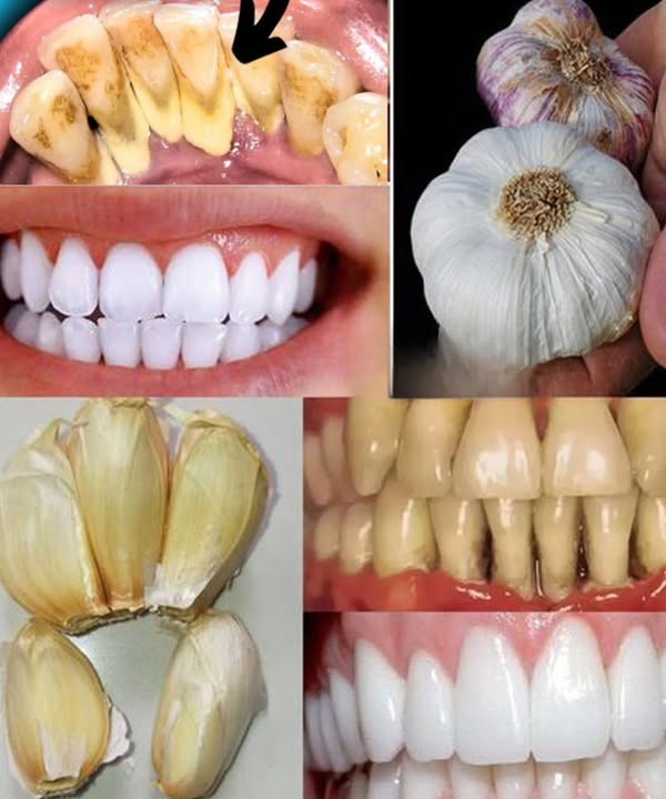 Improve Your Oral Health Naturally with Garlic